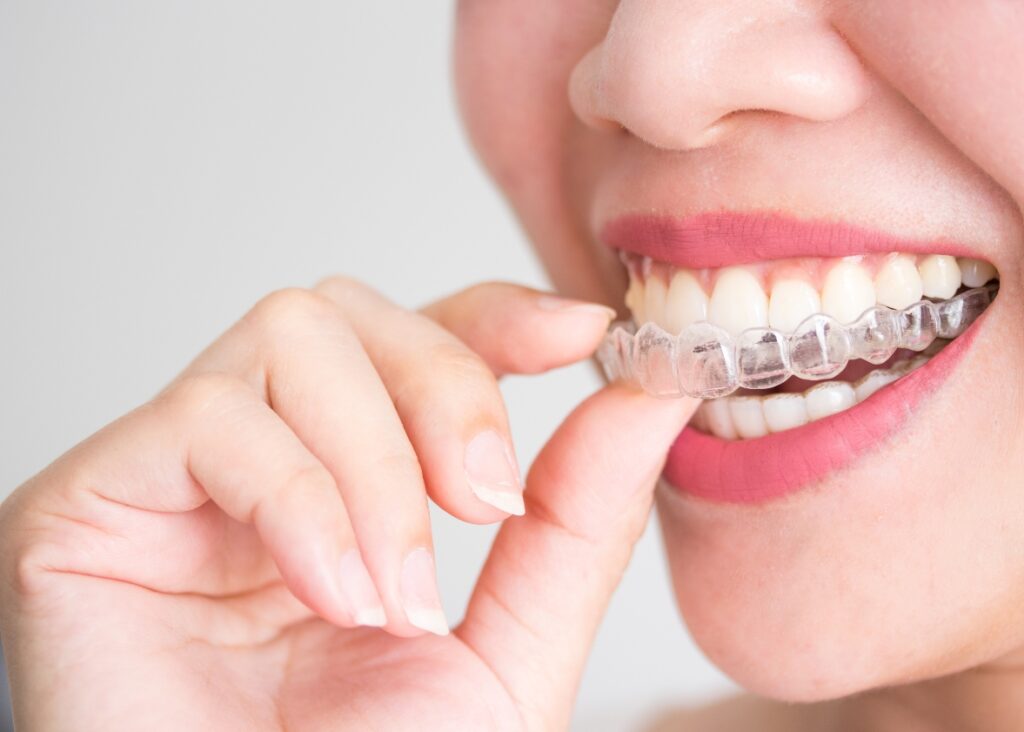 Close-up of Invisalign aligners, showcasing their transparent and sleek design.